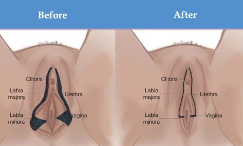 facts about labiaplasty