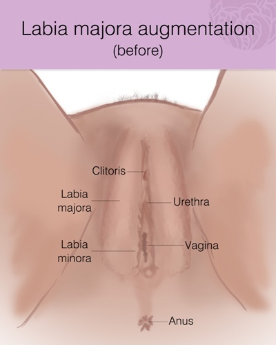 labiaplasty image