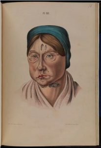 Facts about Leprosy