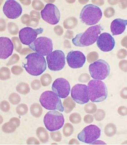 Facts about Leukemia Cancer