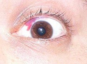 facts about laser eye surgery