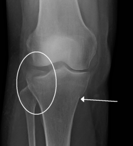 Leg Fracture