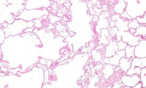 Facts about Lung Disease