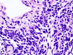 Lung Cancer