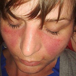 Systemic Lupus